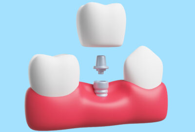 Échecs esthétiques en implantologie : causes, prévention et solutions