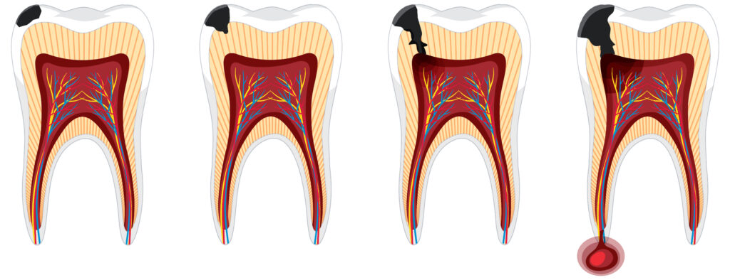 Caries silencieuses