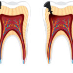 Caries silencieuses