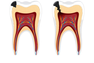 Caries silencieuses