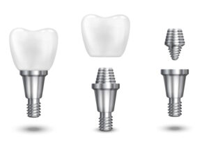 Tarifs implants dentaires